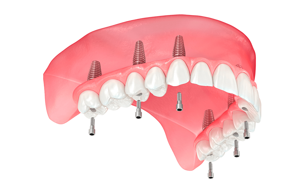 Dental centar Dr. Zahic - All on 4 / All on 6