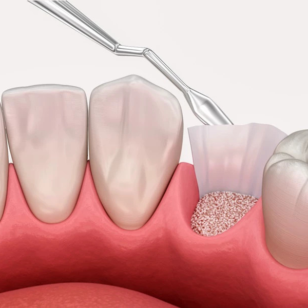 Dental centar Dr. Zahic - Oralna kirurgija