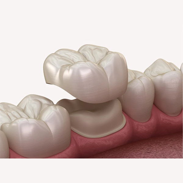 Dental centar Dr. Zahic - Zubne krunice