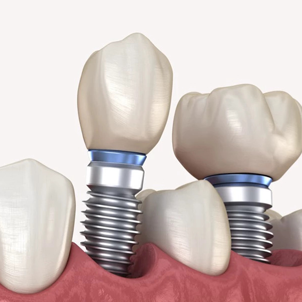 Zubni implantati