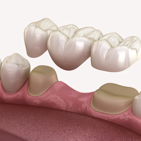 Dental centar Dr. Zahic - Zubni mostovi